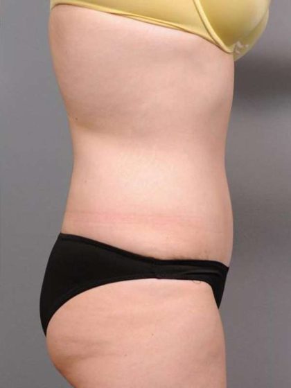 Tummy Tuck Before & After Patient #463