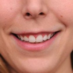 BOTOX® Cosmetic Before & After Patient #2531