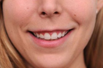 BOTOX® Cosmetic Before & After Patient #2531