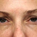 BOTOX&reg; Cosmetic Before & After Patient #2534