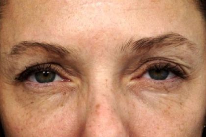 BOTOX® Cosmetic Before & After Patient #2534