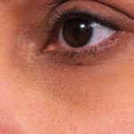 JUVEDERM&reg; Before & After Patient #2537