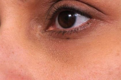 JUVEDERM® Before & After Patient #2537