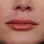 Lip Injections Before & After Patient #2540
