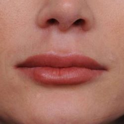Lip Injections Before & After Patient #2540