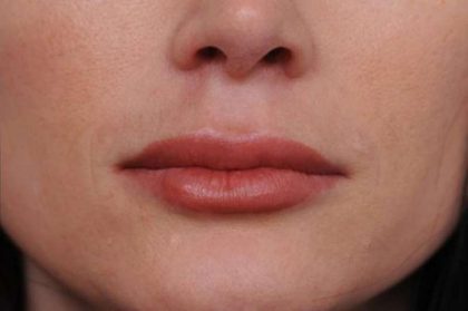 Lip Injections Before & After Patient #2540