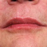 Lip Injections Before & After Patient #2543