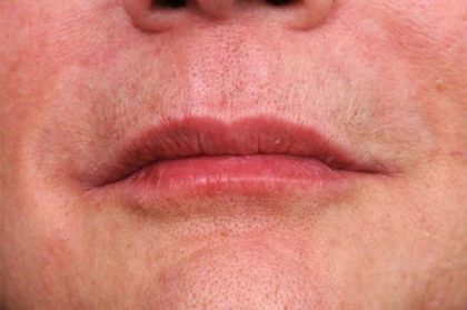 Lip Injections Before & After Patient #2543