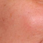 IPL Photofacial Before & After Patient #2548