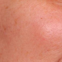 IPL Photofacial Before & After Patient #2548