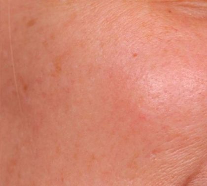 IPL Photofacial Before & After Patient #2548