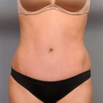 Tummy Tuck Before & After Patient #474