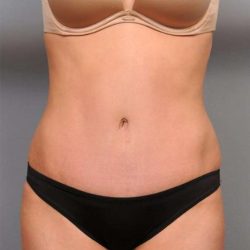 Tummy Tuck Before & After Patient #474