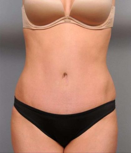 Tummy Tuck Before & After Patient #474