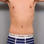 Tummy Tuck Before & After Patient #482