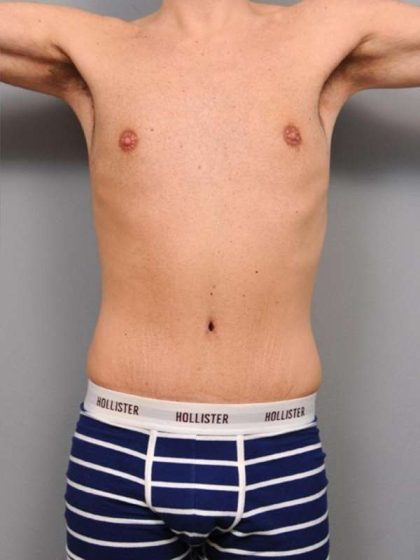 Tummy Tuck Before & After Patient #482