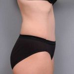 Tummy Tuck Before & After Patient #497