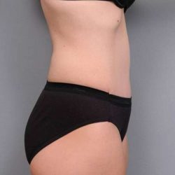 Tummy Tuck Before & After Patient #497