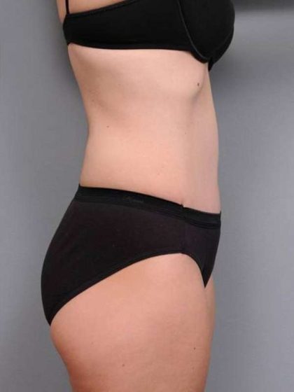 Tummy Tuck Before & After Patient #497