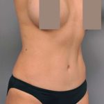Tummy Tuck Before & After Patient #504