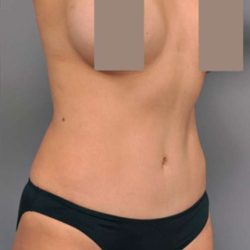 Tummy Tuck Before & After Patient #504