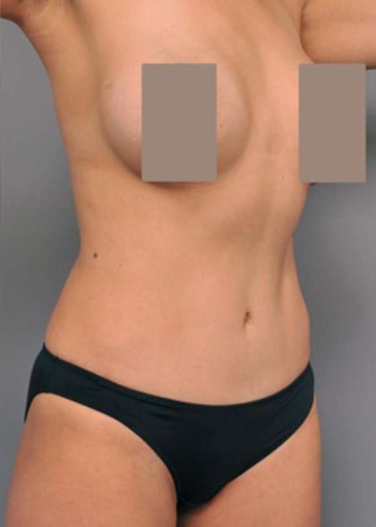 Tummy Tuck Before & After Patient #504