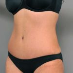 Tummy Tuck Before & After Patient #515