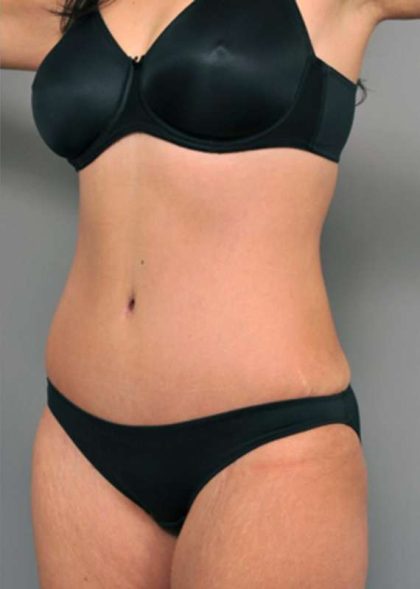 Tummy Tuck Before & After Patient #515