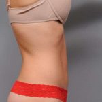 Tummy Tuck Before & After Patient #537