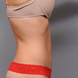 Tummy Tuck Before & After Patient #537