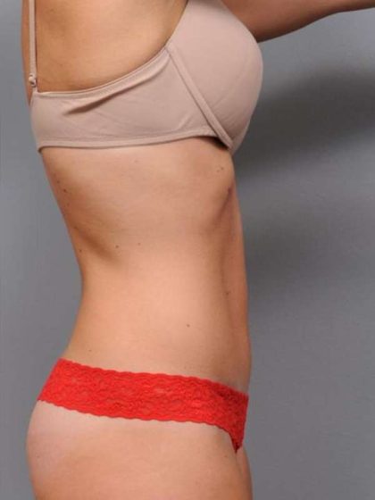 Tummy Tuck Before & After Patient #537