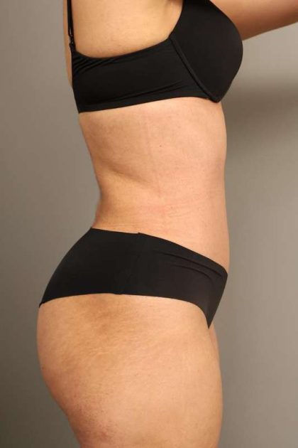 Liposuction Before & After Patient #550