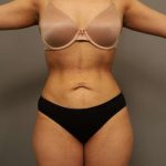 Liposuction Before & After Patient #563