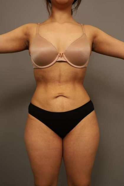Liposuction Before & After Patient #563