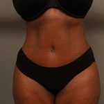 Tummy Tuck Before & After Patient #574