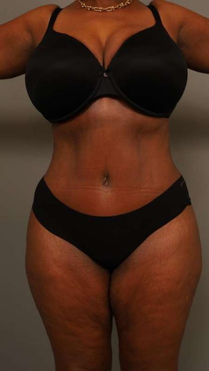 Tummy Tuck Before & After Patient #574
