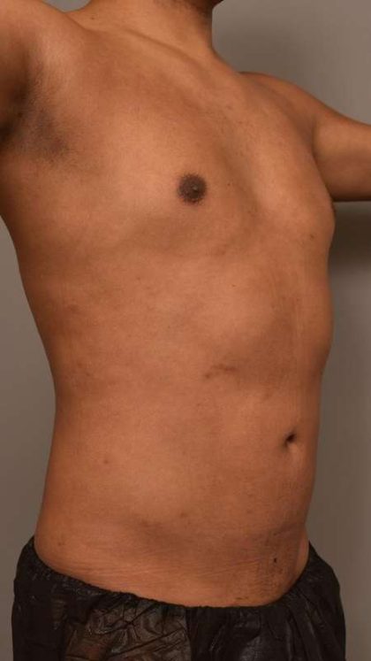 Liposuction Before & After Patient #581