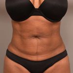 Liposuction Before & After Patient #604