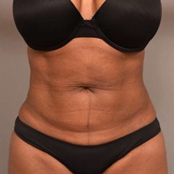 Liposuction Before & After Patient #604