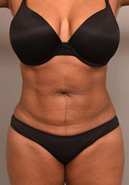 Liposuction Before & After Patient #604