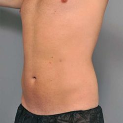 Liposuction Before & After Patient #611