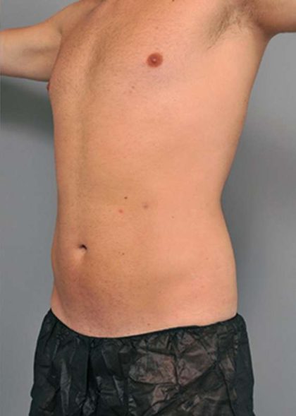 Liposuction Before & After Patient #611