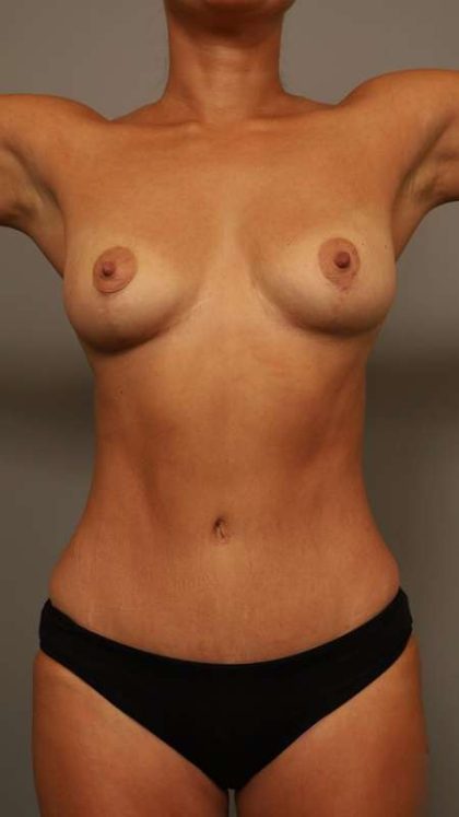 Tummy Tuck Before & After Patient #260