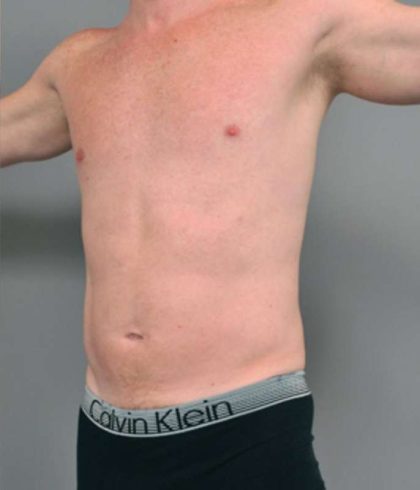 Liposuction Before & After Patient #618