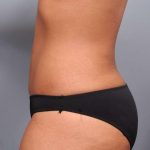 Liposuction Before & After Patient #635