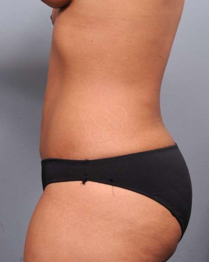 Liposuction Before & After Patient #635
