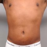 Liposuction Before & After Patient #648