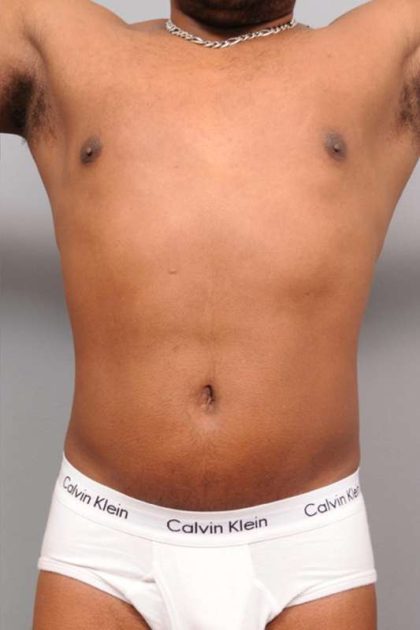 Liposuction Before & After Patient #648