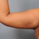 Liposuction Before & After Patient #655