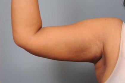 Liposuction Before & After Patient #655